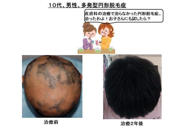 円形脱毛症　病院